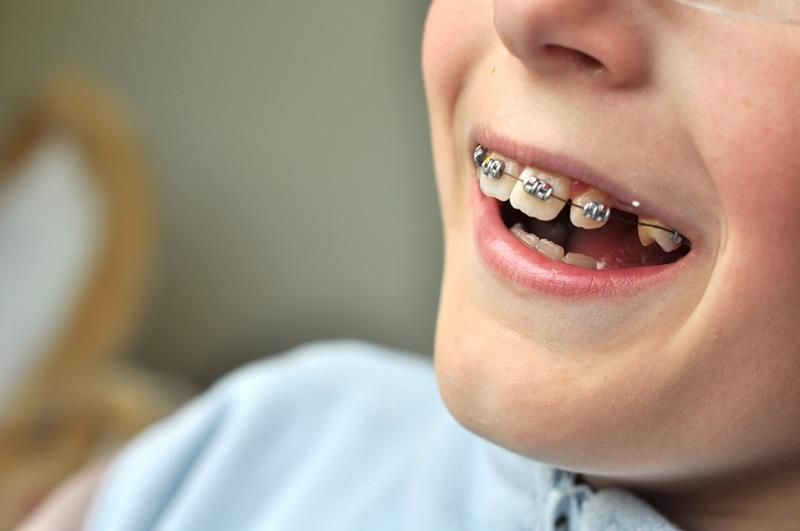 Early Interceptive Orthodontics for kids at Statesboro Pediatric Dentistry
